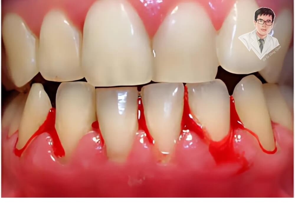 "Viêm nướu chảy máu – Dấu hiệu cảnh báo tụt nướu nguy hiểm!" Hình ảnh viêm nướu gây chảy máu, sưng đỏ và dẫn đến tình trạng tụt nướu răng nếu không điều trị kịp thời.