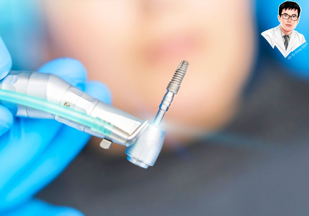 Chi phí implant bao gồm nhiều hạng mục – hiểu rõ để chủ động tài chính.