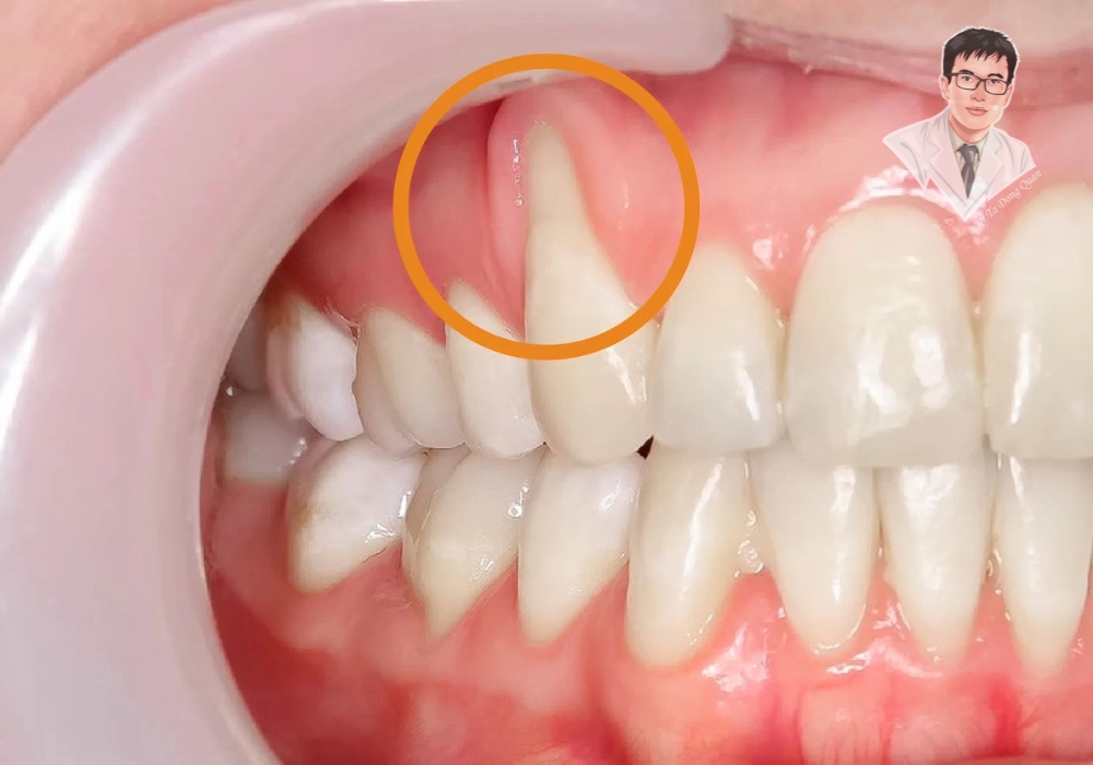 Một trường hợp thực tế của bệnh nhân bị tụt nướu răng. Vùng nướu bị teo lại, chân răng dần lộ rõ, dễ gây ê buốt và nguy cơ viêm nhiễm.