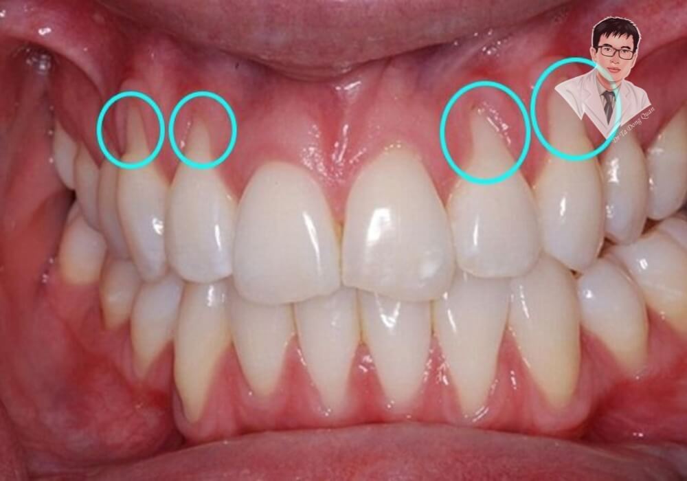  Hình ảnh mô tả chi tiết những dấu hiệu nhận biết của tụt nướu răng, vòng tròn đánh dấu rõ vị trí nướu bị tụt