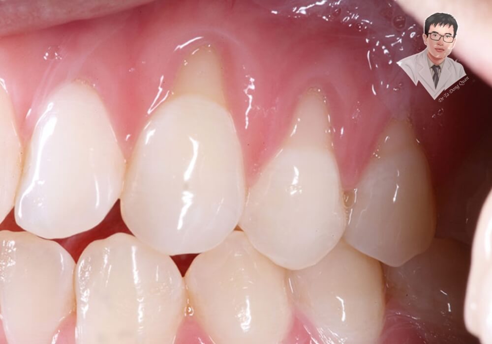 Hình ảnh thể hiện tình trạng tụt nướu răng giai đoạn đầu, khi nướu bắt đầu co rút nhẹ nhưng chưa có biểu hiện nghiêm trọng. Đây là thời điểm quan trọng để ngăn ngừa tiến triển xấu hơn.