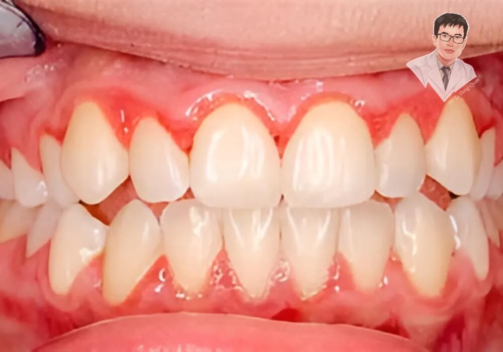 Hình ảnh cận cảnh nướu răng bị tụt, làm lộ chân răng và có thể gây ê buốt nghiêm trọng nếu không điều trị kịp thời.