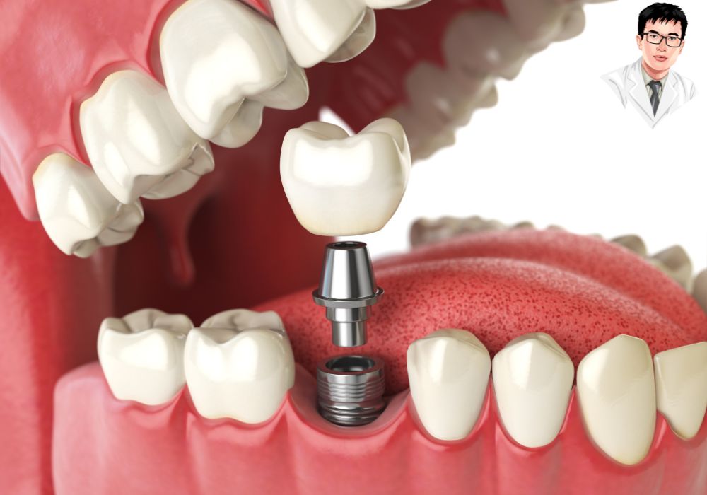 Cận cảnh quy trình đặt trụ implant vào xương hàm dưới, thể hiện rõ cấu trúc mô mềm và implant.