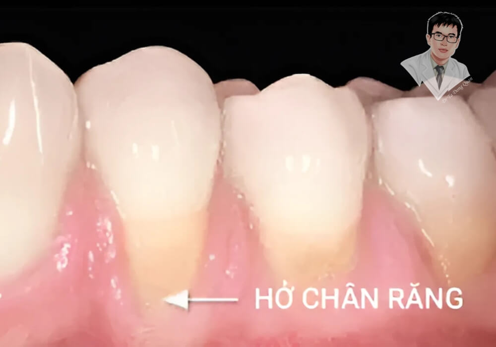 Hình ảnh cho thấy chân răng lộ ra do tụt nướu, gây ê buốt và dễ bị vi khuẩn tấn công. Đây là dấu hiệu sớm của viêm lợi, nếu không điều trị kịp thời có thể dẫn đến viêm nha chu.