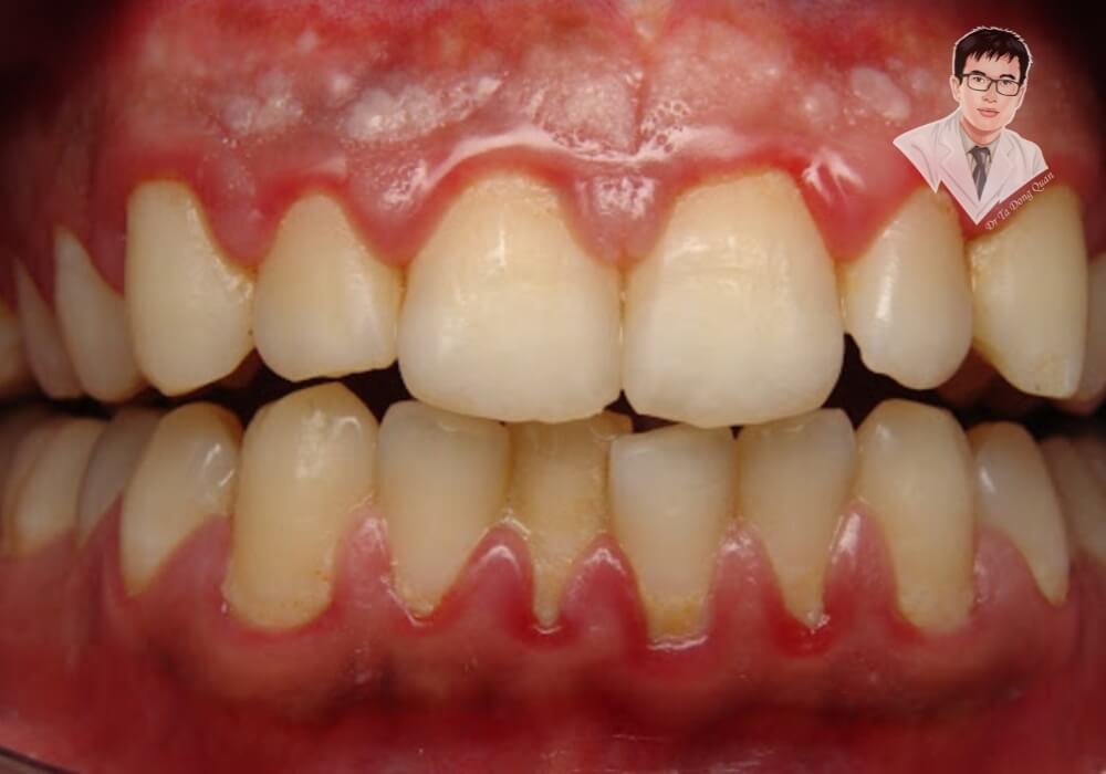 Hình ảnh răng bị viêm nướu nặng, tụt lợi khiến chân răng lộ rõ, dễ tổn thương.