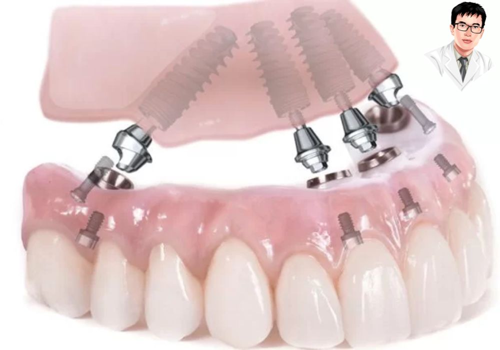 Phục hình toàn hàm chắc chắn chỉ với 4 trụ implant.