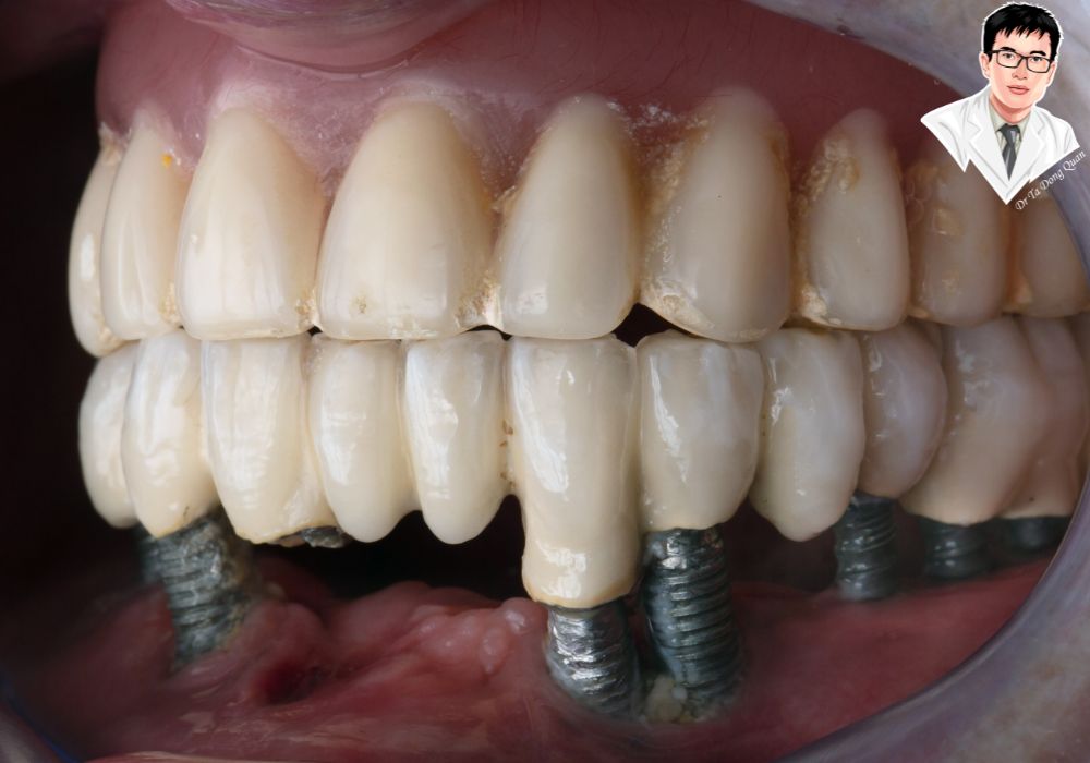 Implant cố định toàn hàm mang lại hàm răng chắc khỏe, thẩm mỹ tự nhiên, giúp phục hồi chức năng ăn nhai hiệu quả.