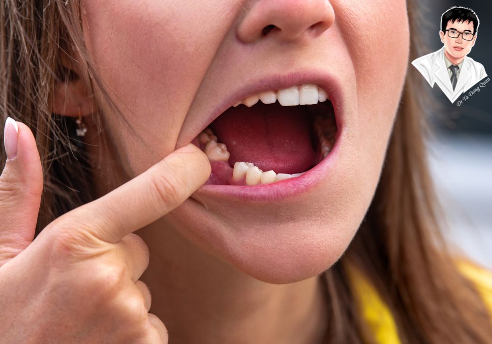 Kiểm tra vị trí mất răng trước khi cấy ghép implant – Bước quan trọng để chẩn đoán điều trị.