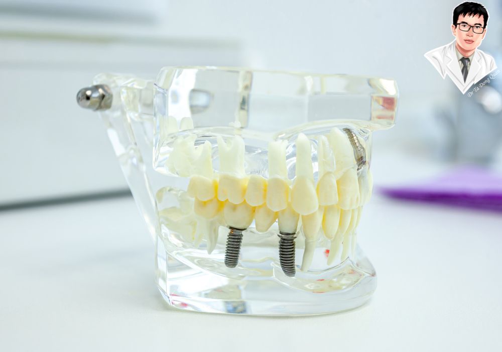 Mô hình implant phục vụ tư vấn y khoa giúp bệnh nhân nắm rõ quy trình và lợi ích của implant cố định toàn hàm.