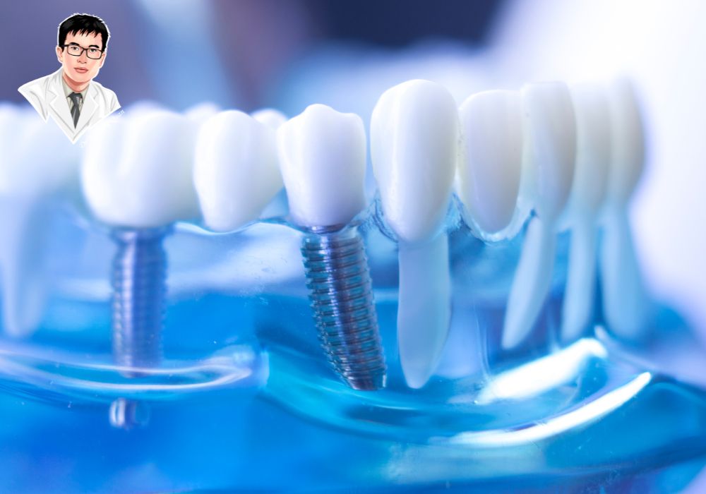 Trụ titanium cấy ghép an toàn, tích hợp xương nhanh, giúp implant cố định toàn hàm trở thành lựa chọn hàng đầu cho người mất răng.