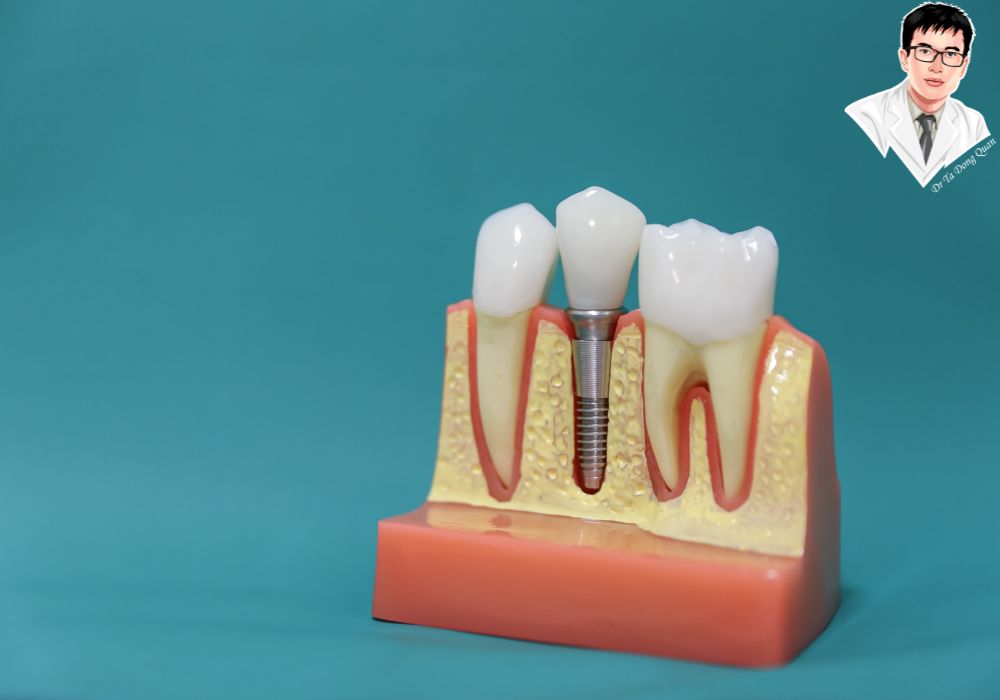 Mô hình răng giả và trụ implant thể hiện chức năng ăn nhai và duy trì cấu trúc xương hàm.