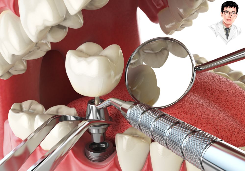 Mô hình 3D thể hiện trụ implant răng bên trong xương hàm với phần răng thật bên cạnh.