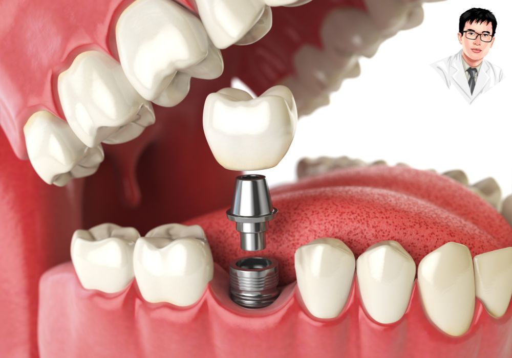 Minh họa quá trình cấy ghép implant – trụ được gắn cố định trong xương hàm