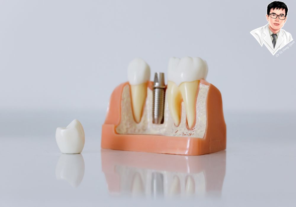 Minh họa quá trình cấy ghép implant – trụ được gắn cố định trong xương hàm