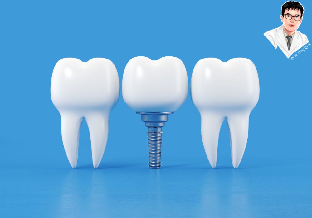 Hiểu đúng từng bước – giảm lo lắng và tăng cơ hội thành công khi trồng implant.