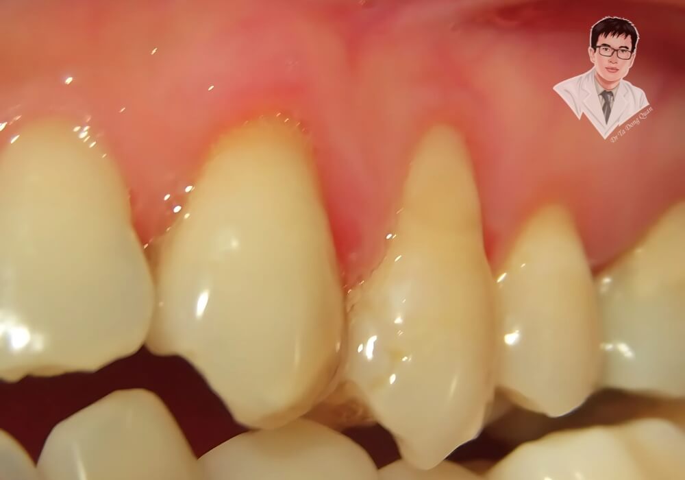 Cận cảnh nướu răng bị tụt do viêm nướu kéo dài. Vi khuẩn và mảng bám tích tụ khiến mô nướu bị phá hủy, làm chân răng lộ dần ra ngoài.