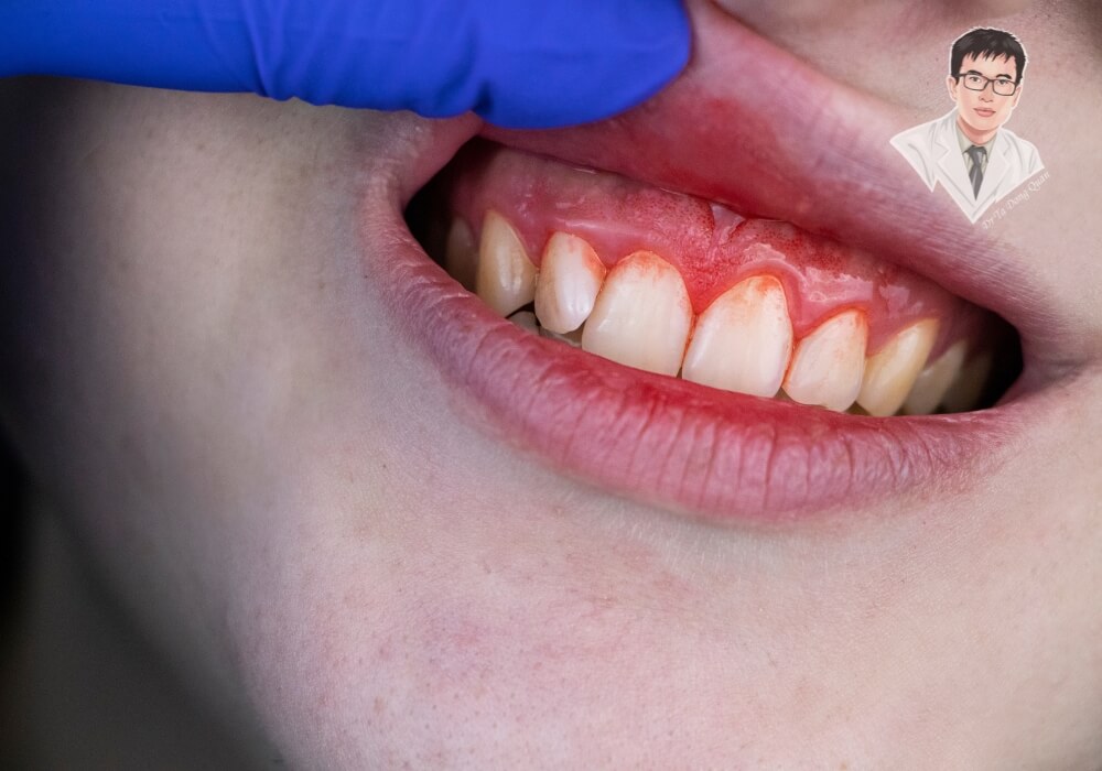 Dấu hiệu tụt nướu bạn không thể bỏ qua! Cận cảnh một người bị tụt nướu với dấu hiệu chân răng bị lộ rõ, nướu đỏ và sưng. Đây là tình trạng phổ biến có thể dẫn đến mất răng nếu không điều trị kịp thời.