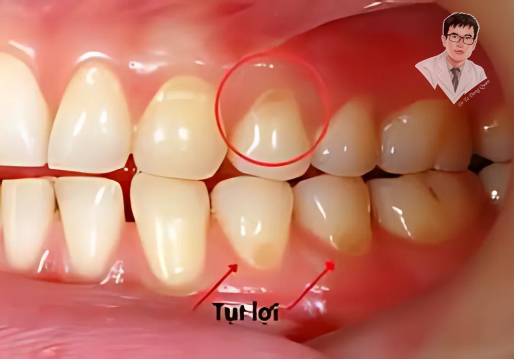 Dấu hiệu nhận biết tụt nướu: Nướu bị rút lên, răng dài hơn bình thường, ê buốt khi ăn uống. Đừng chủ quan nhé! Một trường hợp thực tế của bệnh nhân bị tụt nướu răng. Vùng nướu bị teo lại, chân răng dần lộ rõ, dễ gây ê buốt và nguy cơ viêm nhiễm.