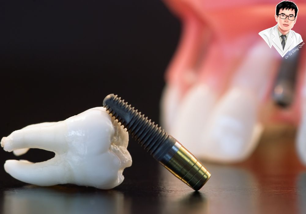 Implant không chỉ bền chắc mà còn giúp ngăn tiêu xương và bảo vệ cấu trúc hàm.
