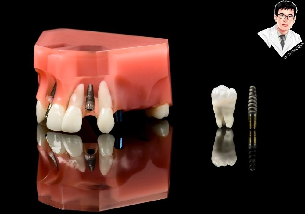 Mão răng sứ implant được hoàn thiện tỉ mỉ, đảm bảo độ vừa khít và thẩm mỹ cao.