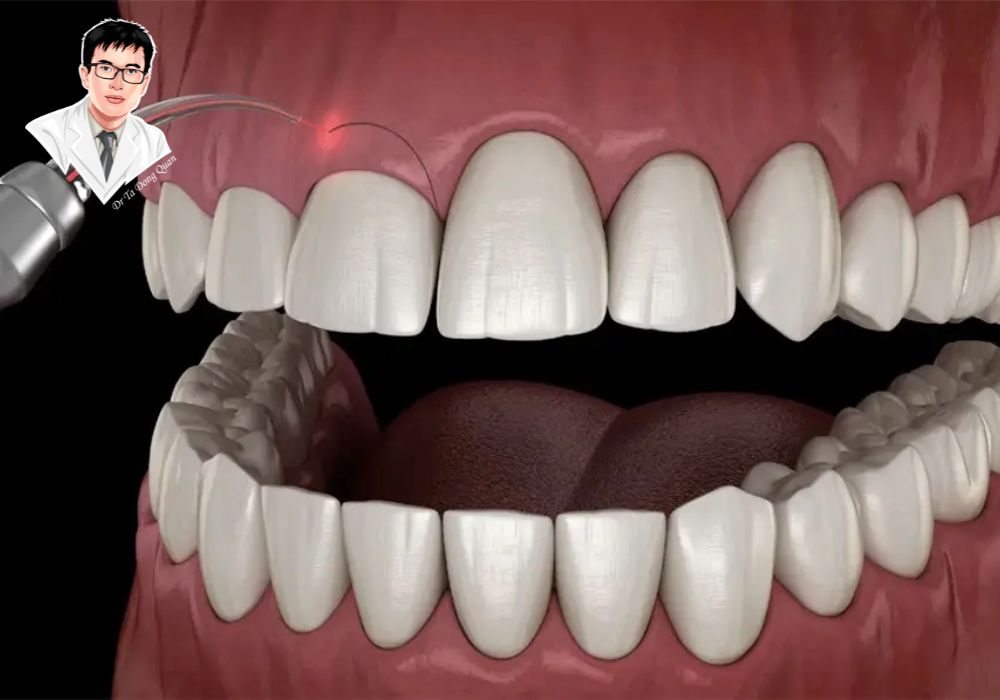 Công nghệ laser trong cắt lợi – An toàn, chính xác và ít đau đớn.