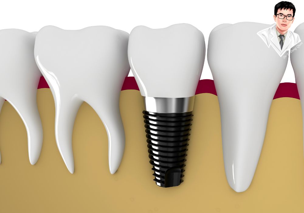 Minh họa chi tiết về các bước cấy ghép implant trong xương hàm và quá trình tích hợp trụ implant với xương.