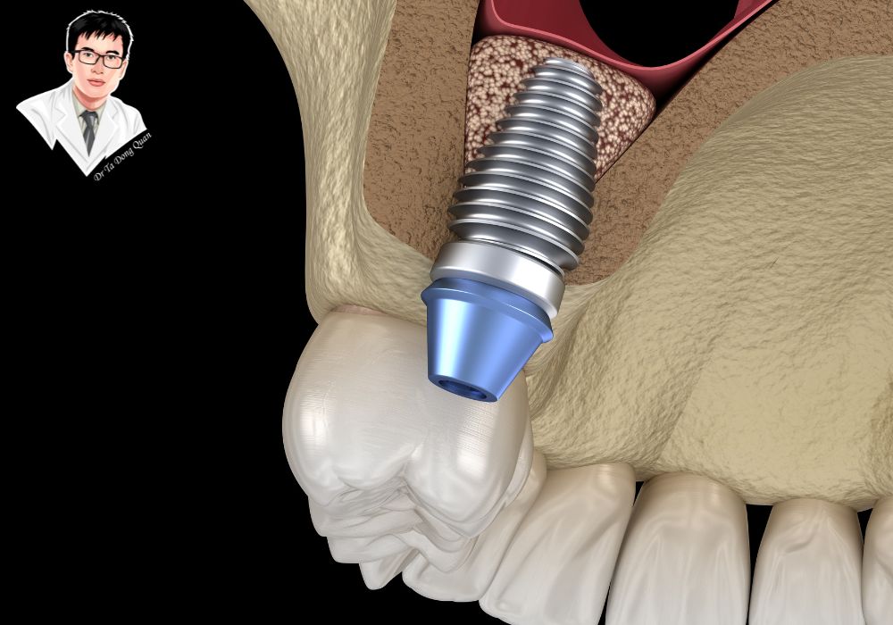 Ghép xương là giải pháp hỗ trợ cần thiết để tăng tỷ lệ thành công của ca implant.