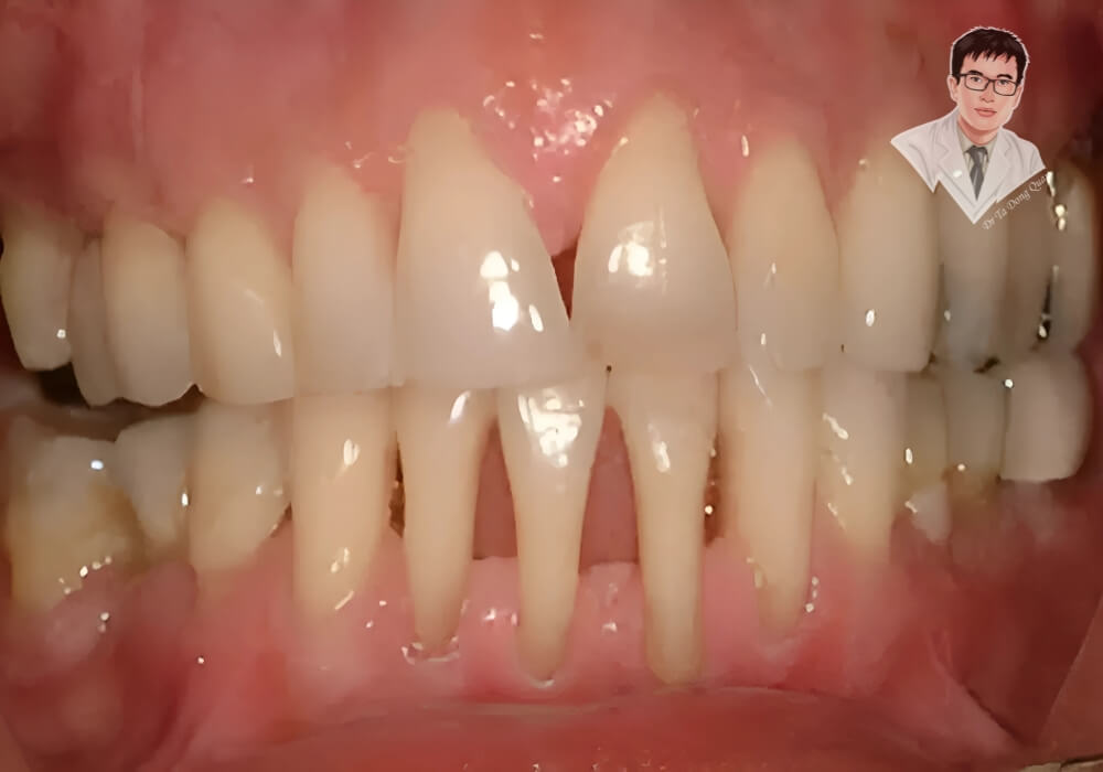  Hình ảnh răng bị tụt nướu nghiêm trọng, lộ rõ chân răng dài, gây ê buốt và ảnh hưởng đến chức năng nhai. Nếu không được điều trị kịp thời, tình trạng này có thể dẫn đến mất răng và các vấn đề răng miệng khác.