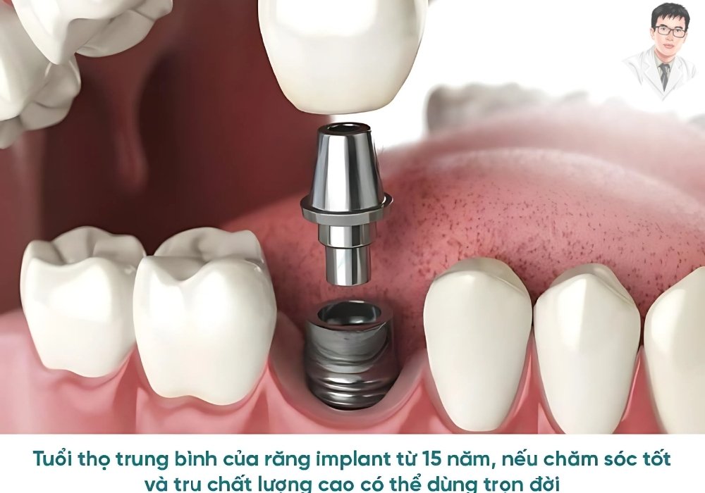 So sánh trực quan giữa implant trọn đời và cầu răng sứ có tuổi thọ ngắn hơn.