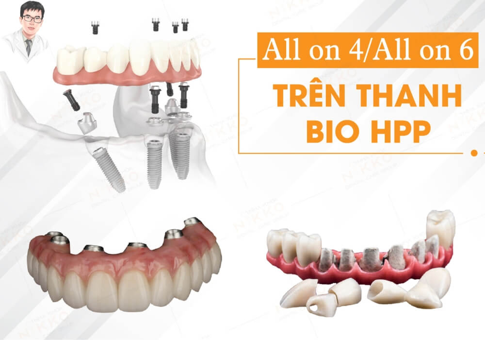 Hình ảnh mô phỏng kỹ thuật All-on-4 và All-on-6 sử dụng thanh Bio HPP giúp phục hồi răng nguyên hàm nhanh chóng, thẩm mỹ.