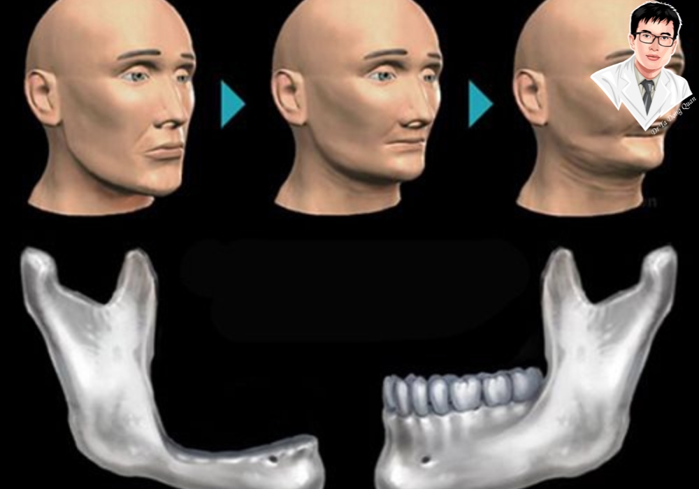 Hình minh họa sự thay đổi cấu trúc khuôn mặt khi bị tiêu xương hàm do mất răng lâu ngày, và quá trình khôi phục gương mặt sau khi cấy ghép implant.