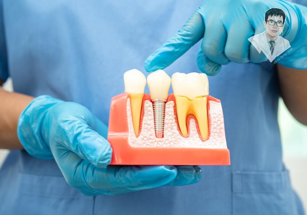 Bác sĩ sử dụng mô hình minh họa trụ implant trên răng thật, giải thích rõ ràng về cấu trúc và lợi ích của implant.