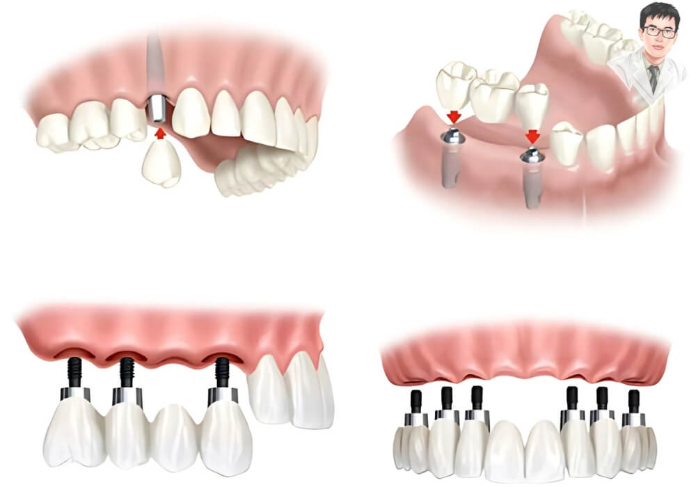 So sánh trực quan giữa cấy ghép Implant, cầu răng và hàm tháo lắp trong điều trị mất răng.