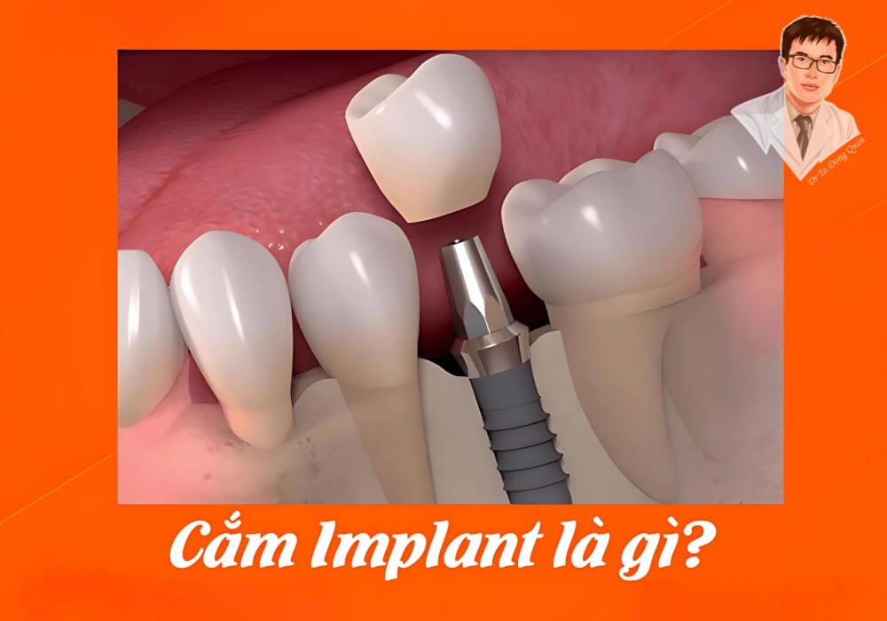 Hình minh họa quá trình cắm trụ implant vào xương hàm thay thế răng đã mất, thể hiện rõ ba phần cơ bản của một răng implant.