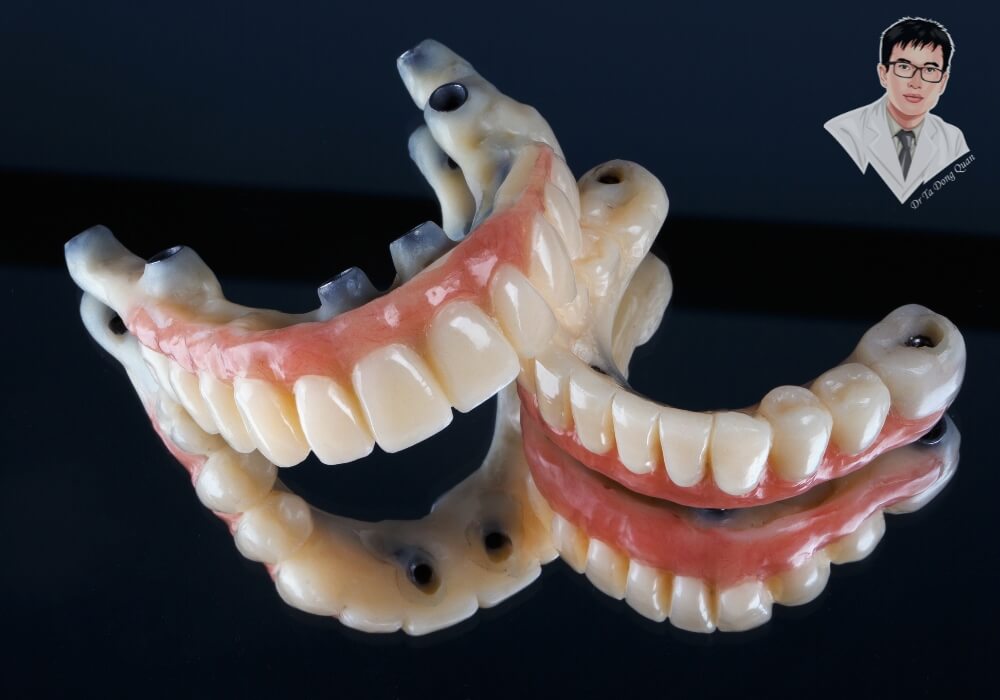 Hình ảnh mô phỏng bộ phục hình căm răng Implant toàn hàm với thiết kế tinh xảo, màu sắc giống răng thật, gắn kết chắc chắn trên khung hàm giả.