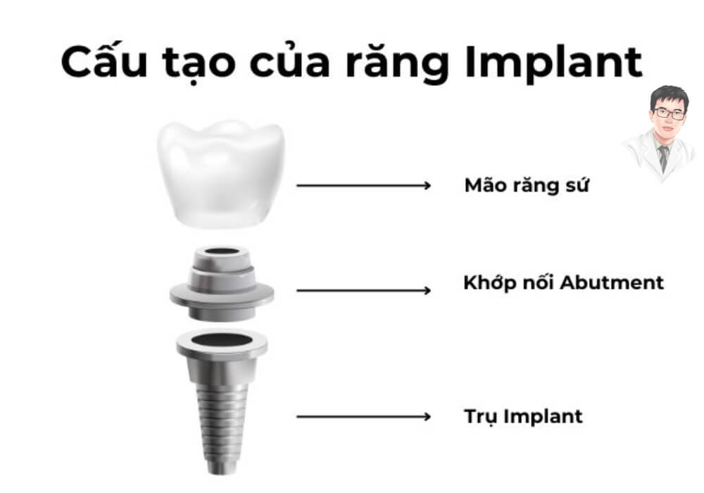 Hình ảnh giải thích về cấu tạo của răng implant, bao gồm trụ implant, khớp nối Abutment và mão răng sứ.