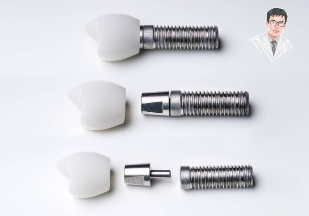 Trụ Implant – Khớp nối – Mão sứ: Bộ 3 hoàn chỉnh tạo nên răng giả chắc như thật. Ảnh cận cảnh cấu tạo đầy đủ của răng Implant gồm 3 phần: mão sứ, khớp nối và trụ Titanium, đặt trên nền trắng y tế.