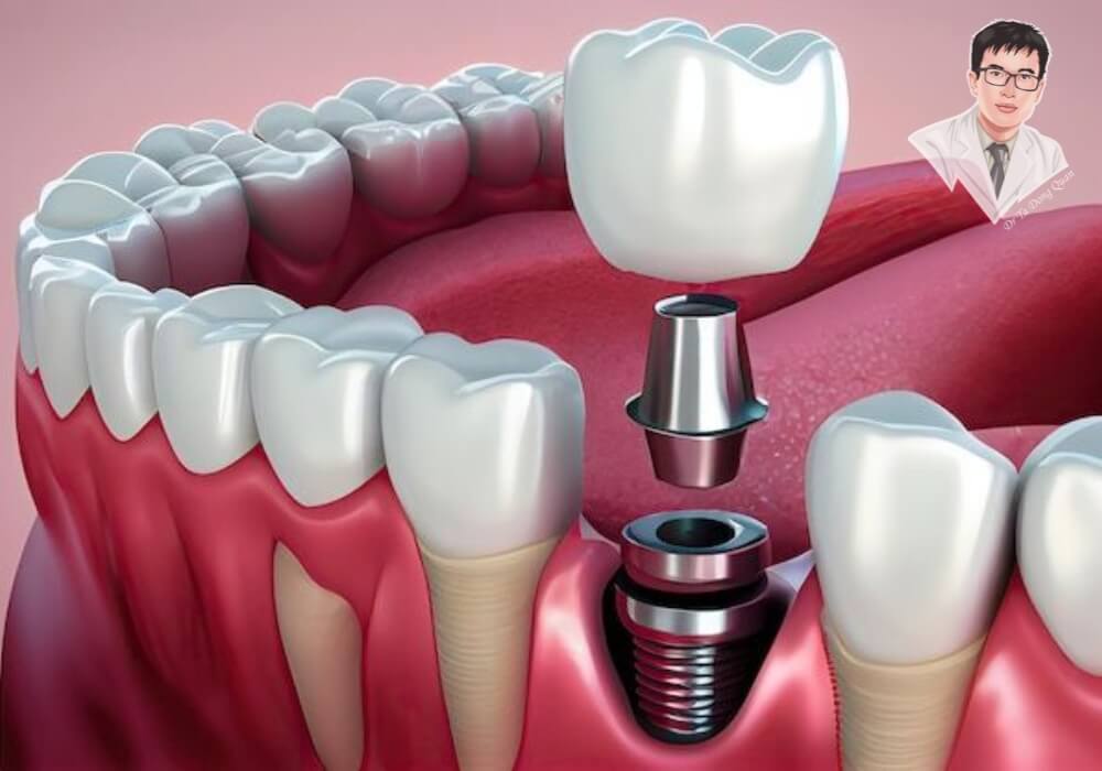 Mô phỏng cấu tạo trụ Implant trong xương hàm và răng sứ bên trên, giúp người xem hiểu rõ quá trình phục hình răng.
