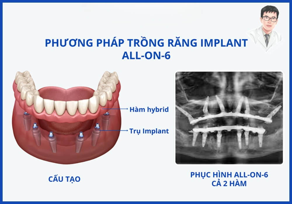 Hình ảnh minh họa cấu tạo phương pháp trồng răng Implant All On 6, bao gồm trụ Implant và phục hình toàn hàm cả hai hàm.
