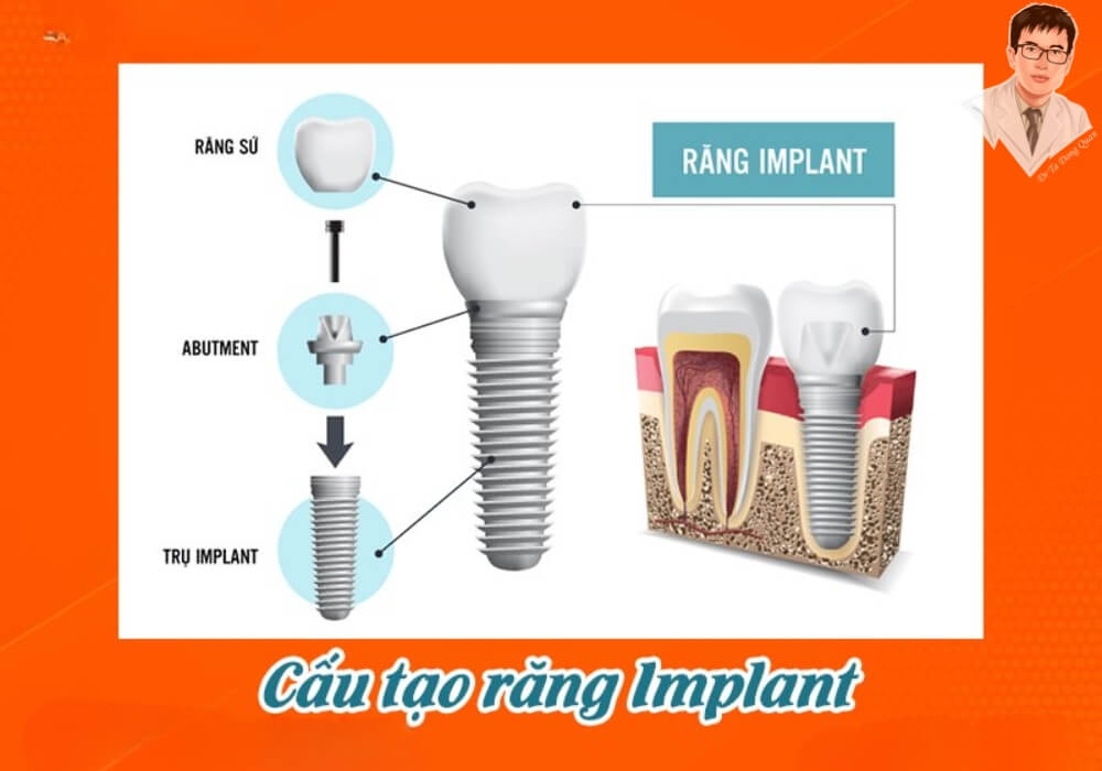 Lắng nghe bác sĩ tư vấn kỹ lưỡng trước khi quyết định trồng răng Implant! Bác sĩ đang tư vấn chi tiết về kế hoạch trồng răng Implant, giúp bệnh nhân hiểu rõ quy trình, thời gian và loại trụ phù hợp.