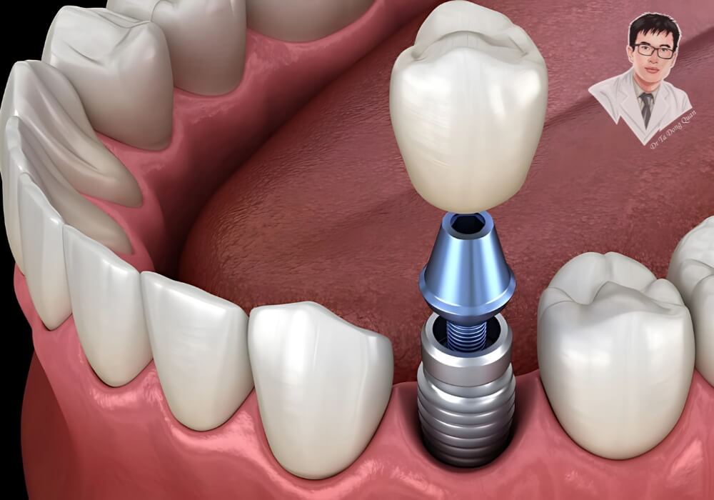 Hình ảnh mô phỏng chi tiết răng implant với trụ titanium, khớp nối và mão sứ gắn trên xương hàm.