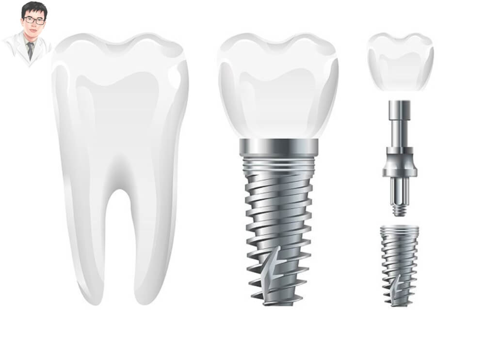  Hình ảnh so sánh cấu tạo của răng thật và răng implant, bao gồm trụ titanium, abutment và mão sứ.