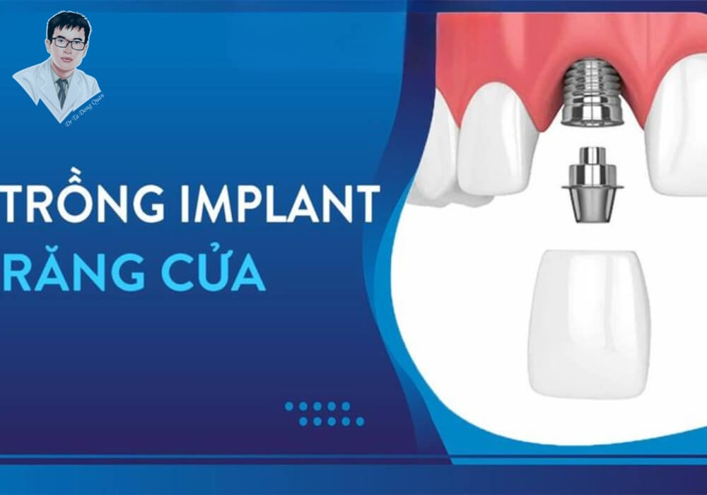 Mô phỏng cấu tạo trụ implant và mão sứ khi phục hình răng cửa bằng implant.
