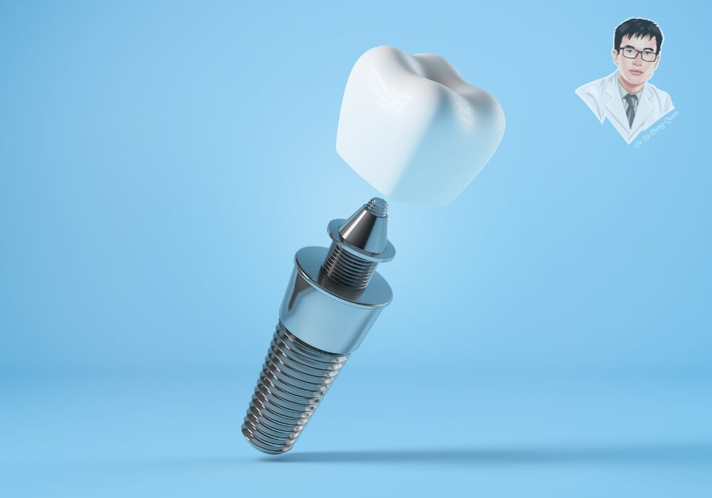 Hình ảnh trụ implant, abutment và mão sứ trong phục hình răng mất.