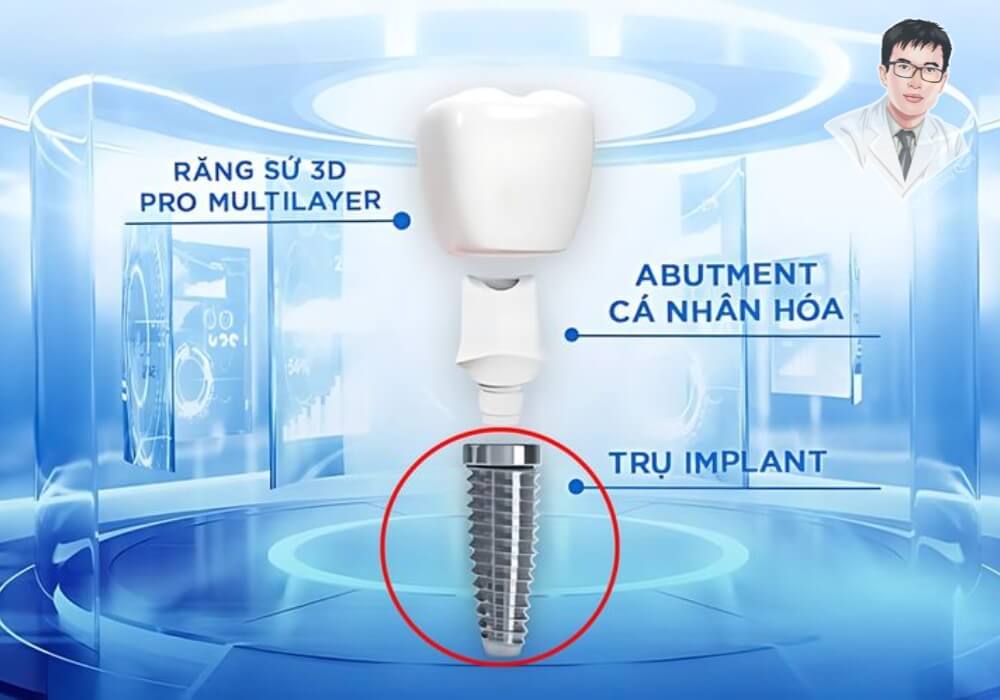 Cấu tạo trụ Implant bao gồm trụ titanium, khớp nối Abutment và mão sứ được thiết kế cá nhân hóa.