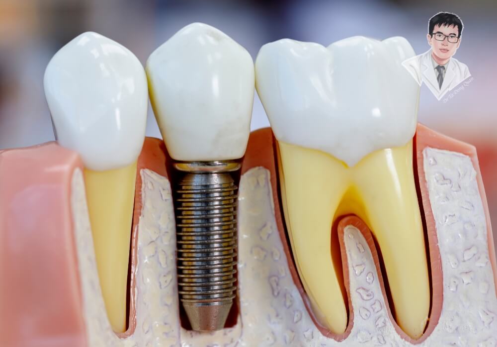 So sánh chi tiết giữa trụ implant và răng thật, làm nổi bật điểm tương đồng về chức năng và thẩm mỹ.