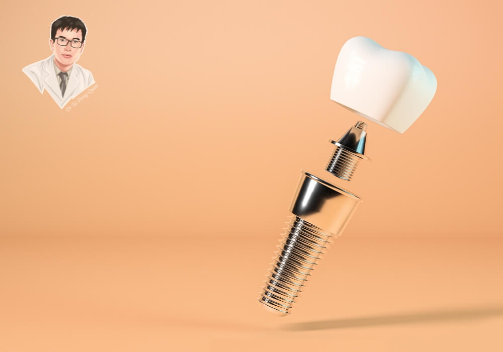 Hình ảnh 3D cấu tạo một trụ implant đơn lẻ, thể hiện chi tiết phần trụ, abutment và mão răng sứ trên nền màu nổi bật.