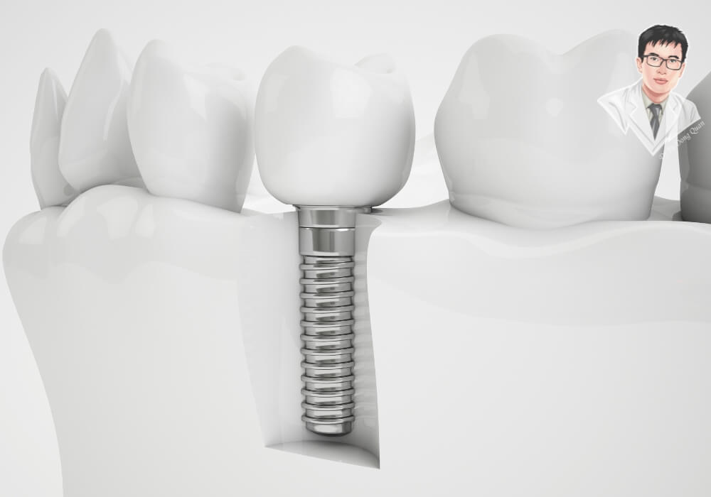 Hình ảnh mô phỏng kỹ thuật cấy ghép implant với trụ titanium cấy vào xương hàm và mão sứ lắp phía trên, sát khít với răng thật hai bên.