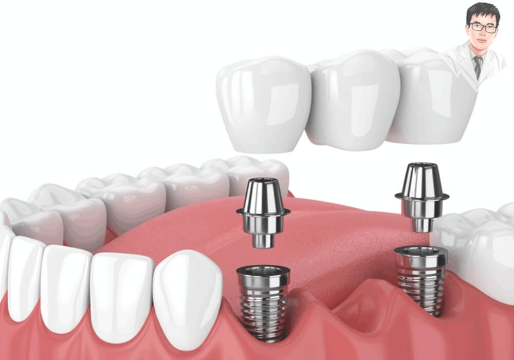 Hình ảnh minh họa quá trình cấy ghép implant cho người mất răng lâu năm, cho thấy các trụ implant được đặt vào xương hàm.