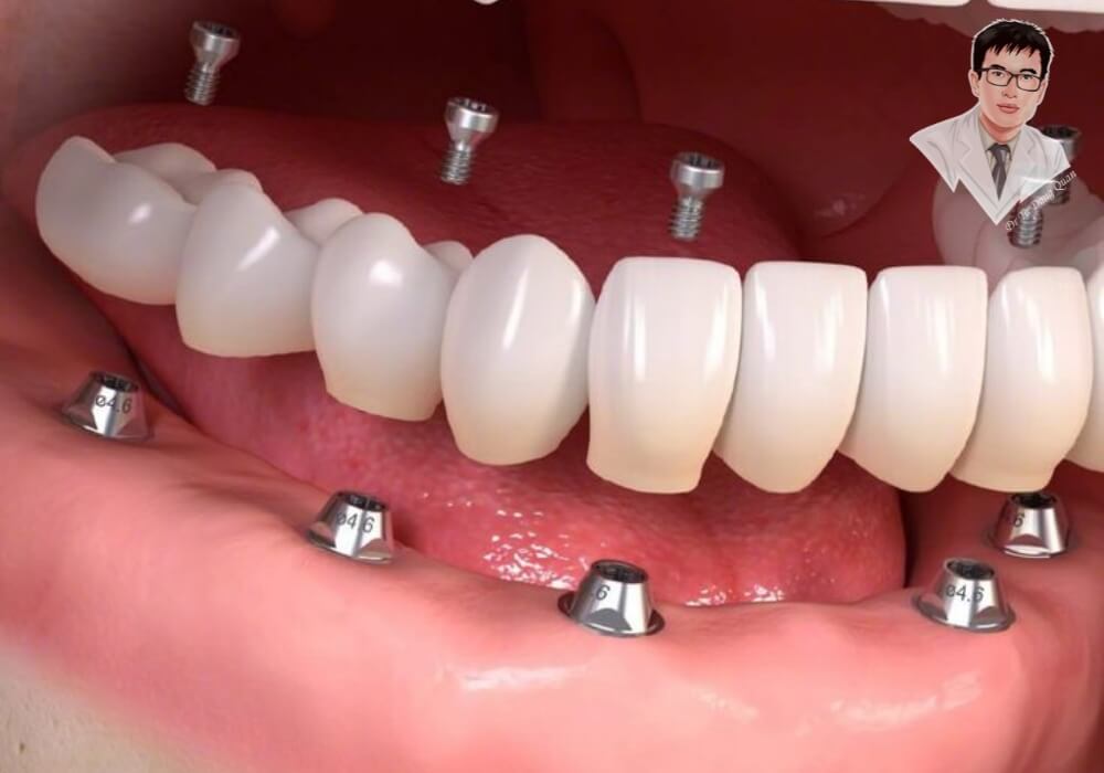  Cận cảnh quy trình cấy ghép implant nguyên hàm với nhiều trụ titanium tích hợp trong xương hàm, giúp phục hồi toàn bộ răng đã mất.